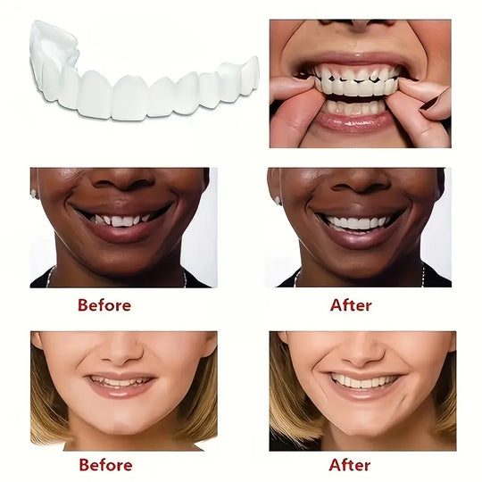 Snap On Smile Braces Teeth Kit For Men & Women | Buy 1 Get 1 Free