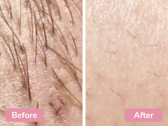 IPL Laser Hair Remover™